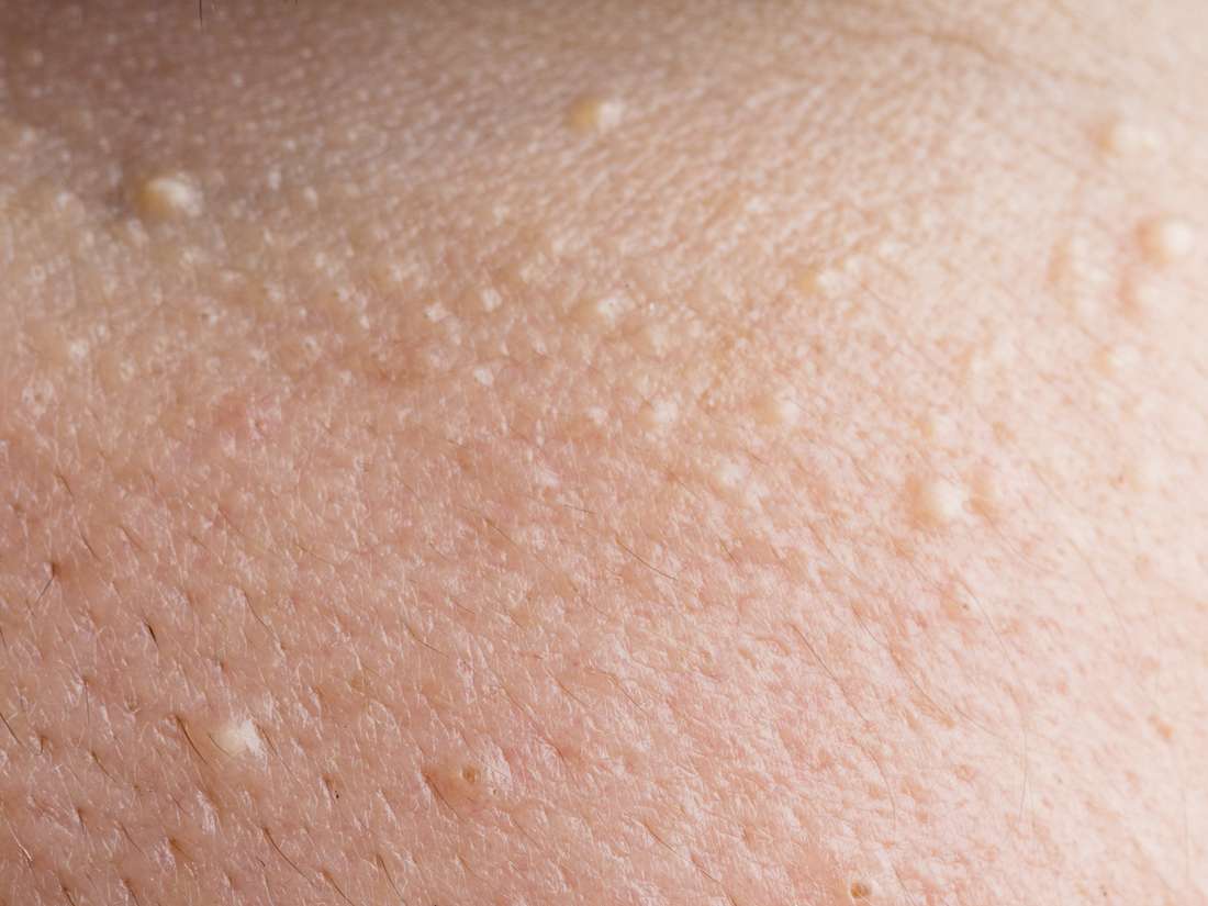 Small White Itchy Bumps On Skin Images And Photos Finder