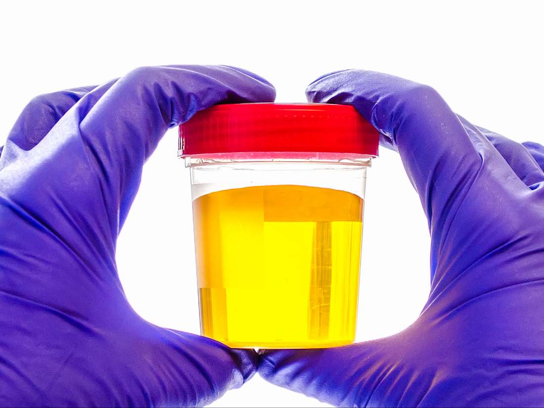Bright yellow urine Colors, changes, and causes