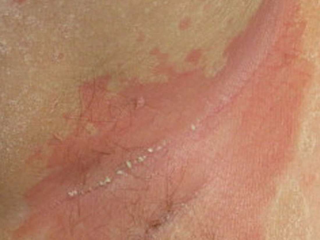 psoriasis arthrosis kezelése)