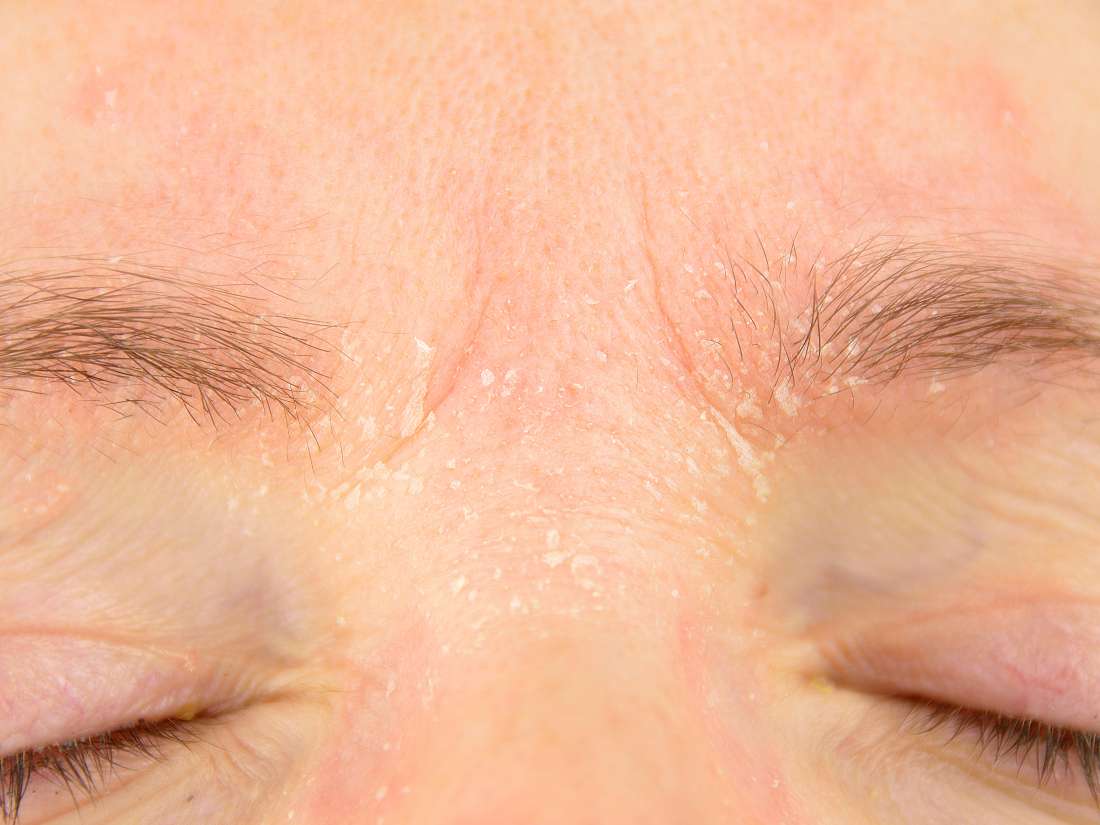 Psoriasis on the eyelids Symptoms, causes, and treatment