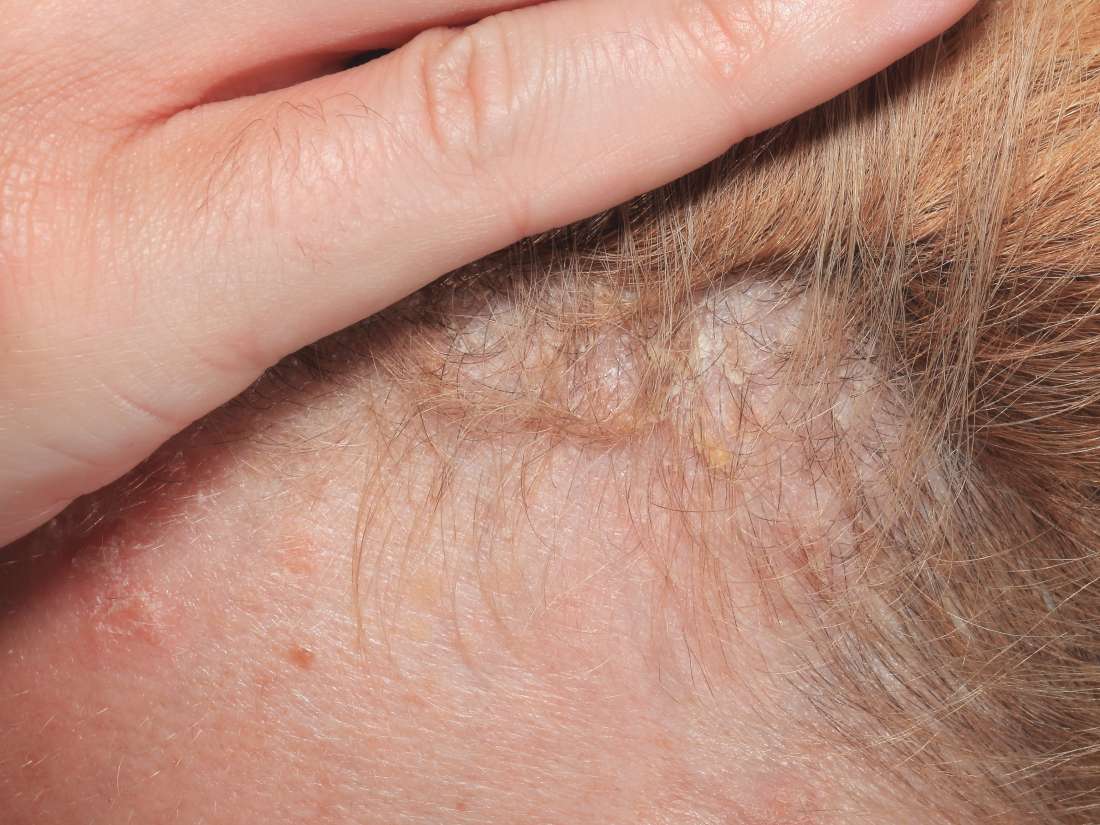 scalp-psoriasis-symptoms-causes-and-treatment