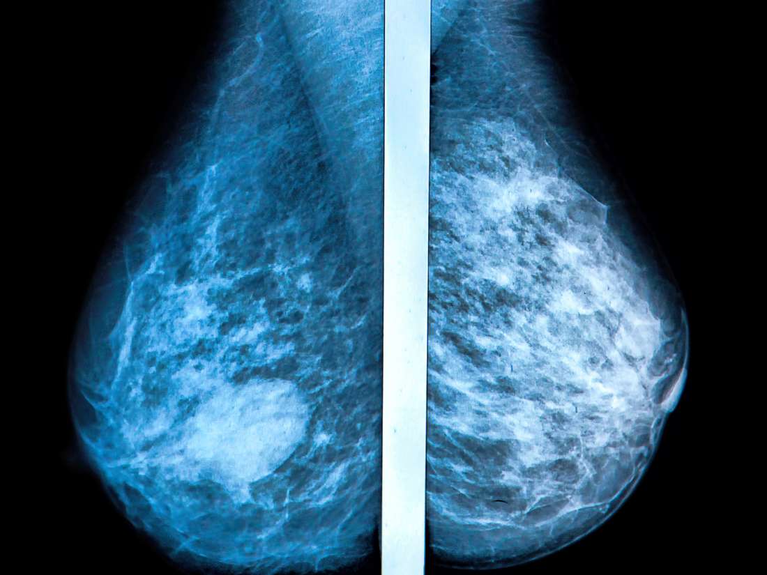 do fibrocystic breast changes lead to cancer