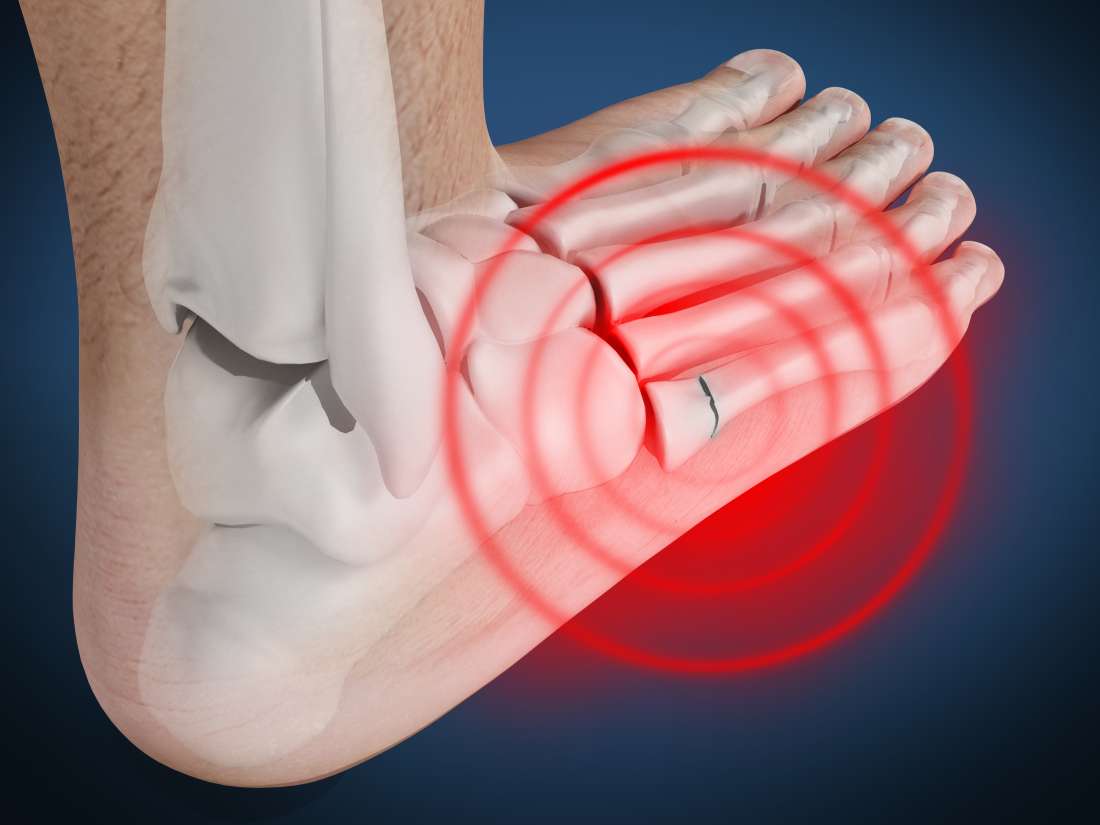 jones fracture treatment