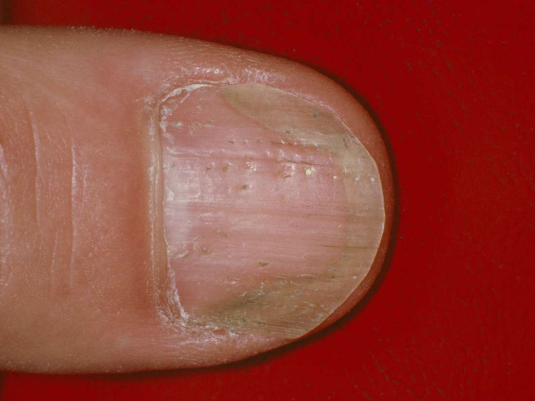 Nail Psoriasis Or Fungus Differences Symptoms And Outlook