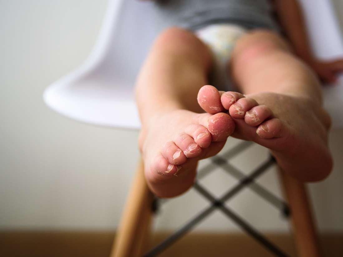 Psoriasis in children Symptoms, treatments, and causes