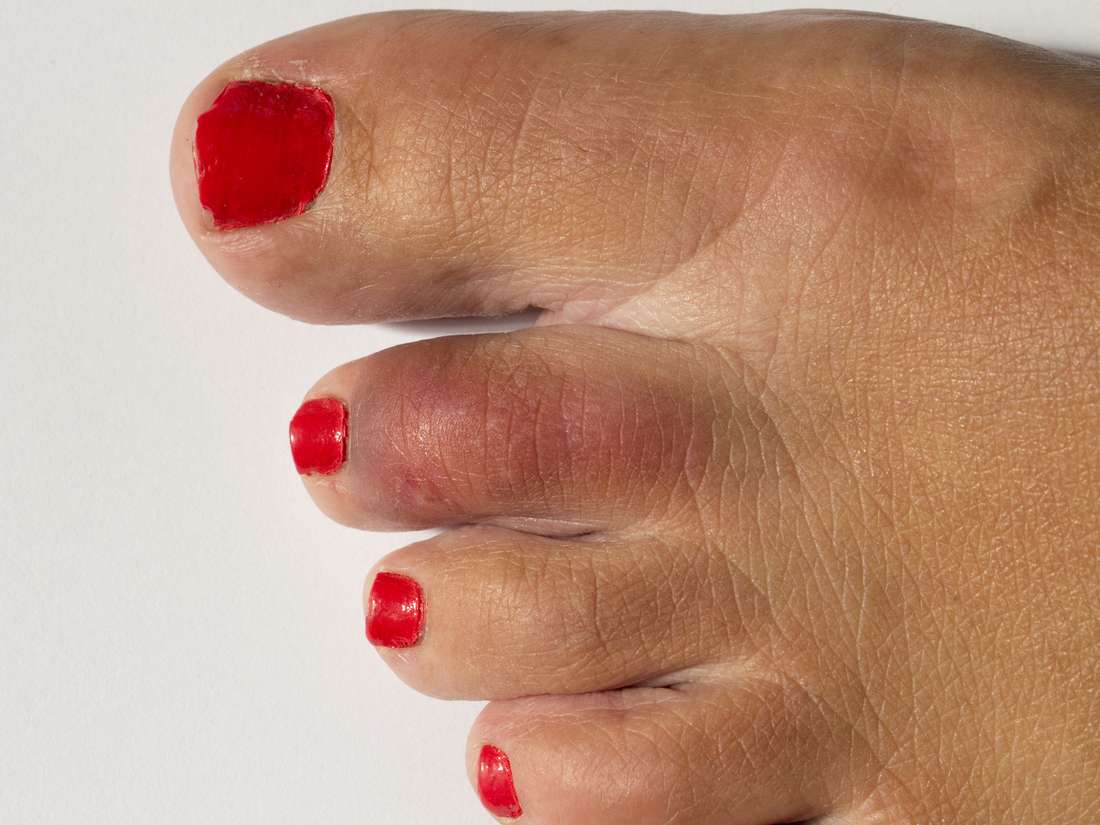 second-toe-pain-causes-and-how-to-get-relief