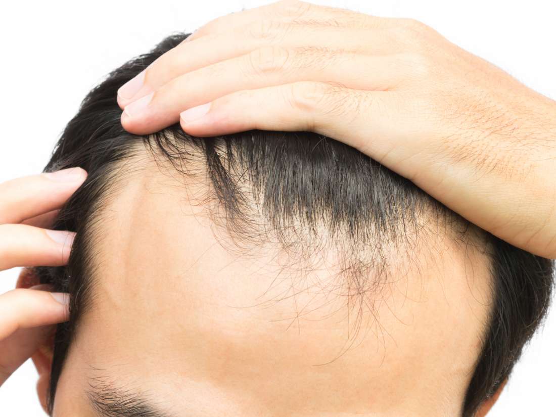 Receding Hairline Treatment Stages And Causes