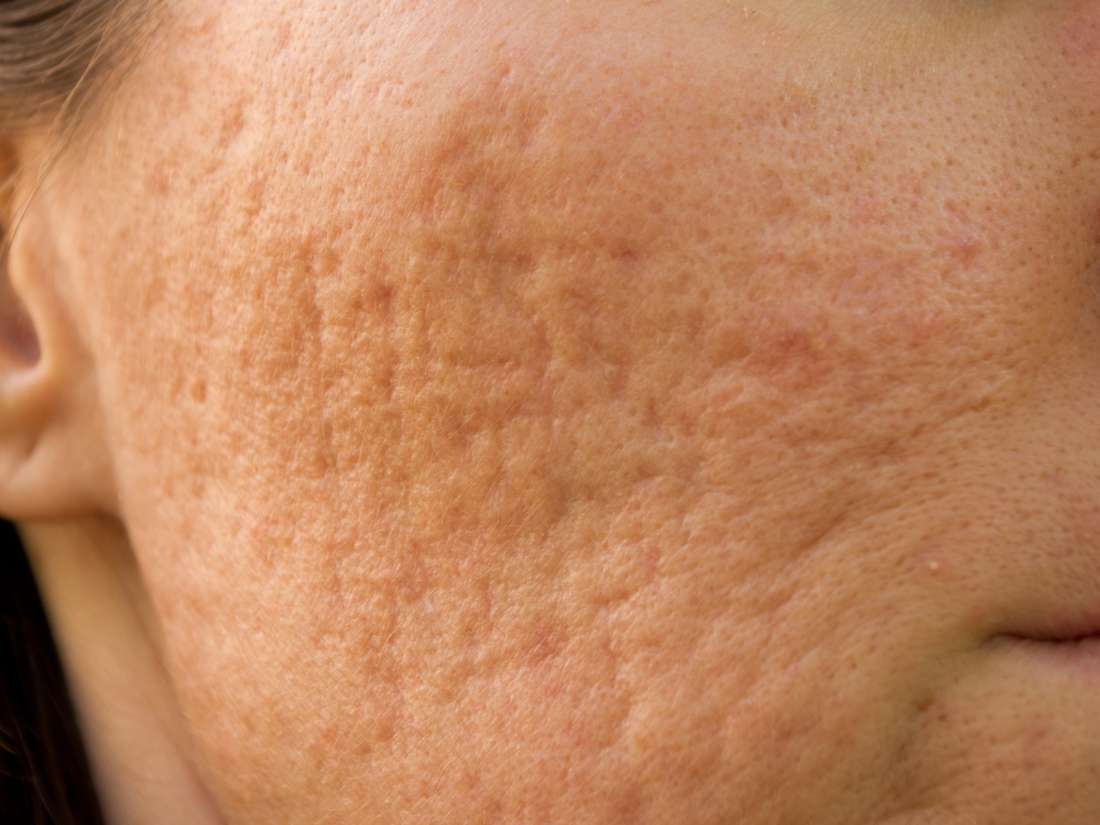 Pockmarks: Definition, causes, and treatment