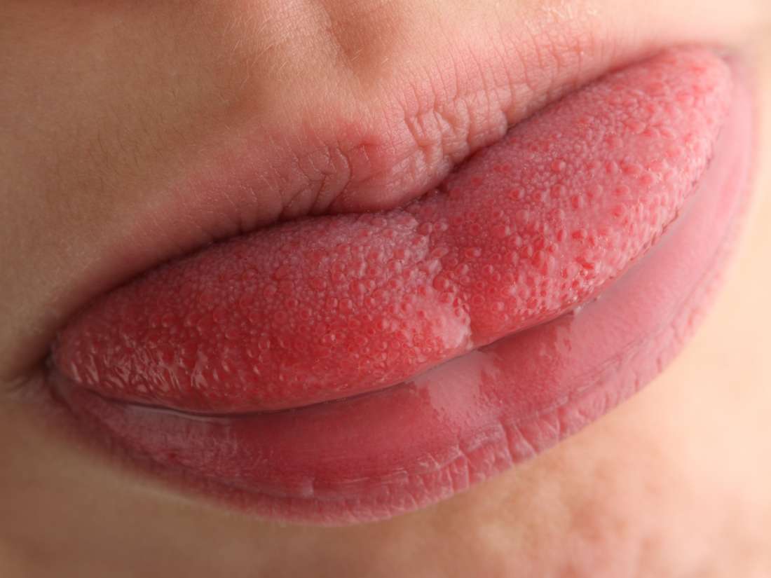 Swollen Taste Buds Causes, Diagnosis, And Treatment-9404