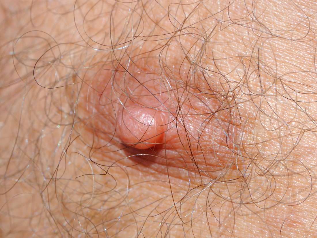 Third Supernumerary Nipple Types Causes And Removal