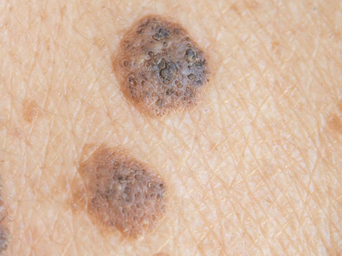 Seborrheic Keratosis Vs Melanoma What s The Difference 