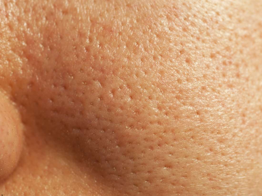 How to get rid of large pores: The top 8 ways