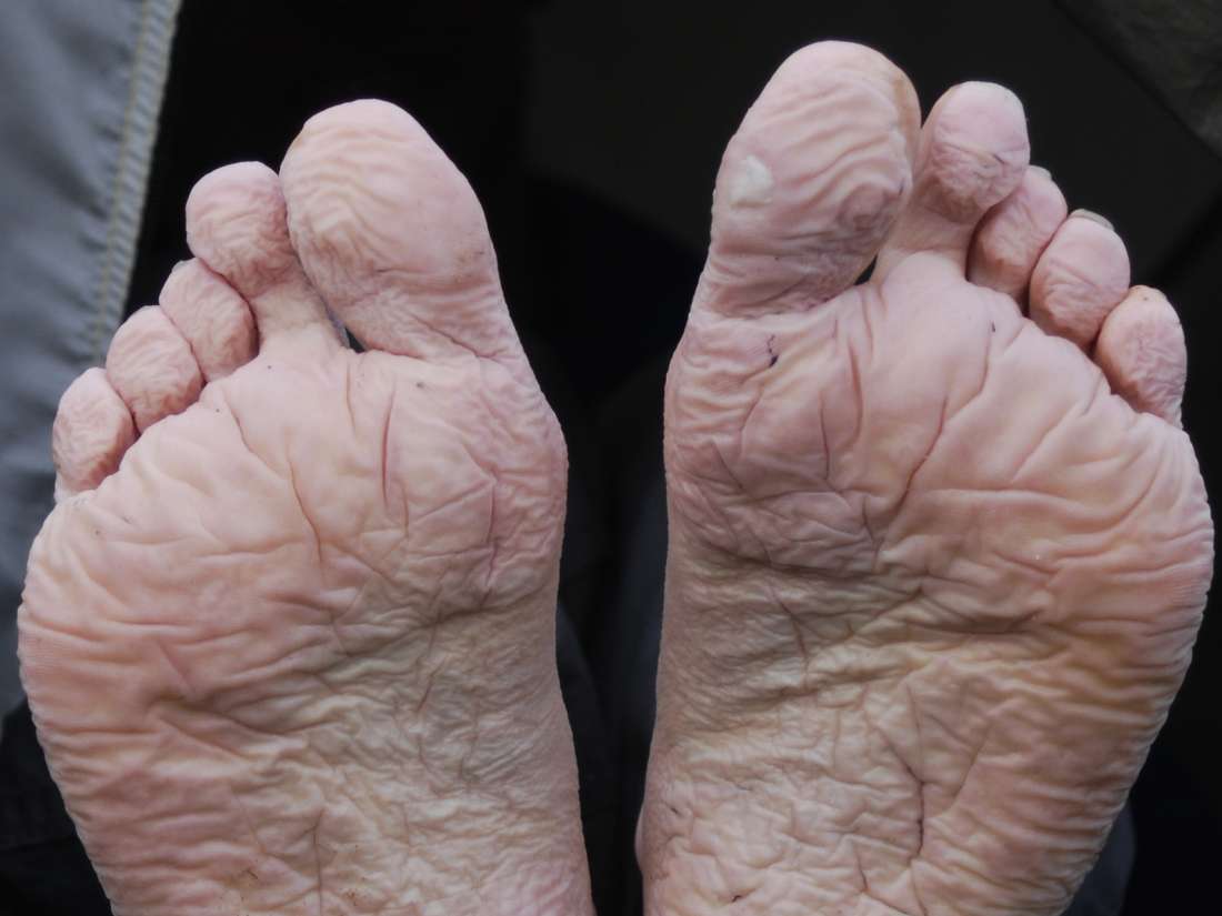 trench-foot-symptoms-causes-treatment