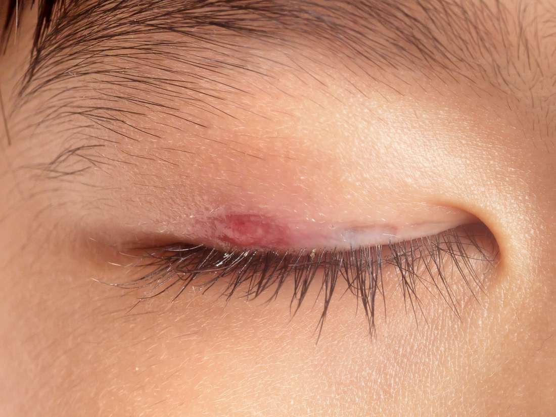 White Patch Above Eyelid