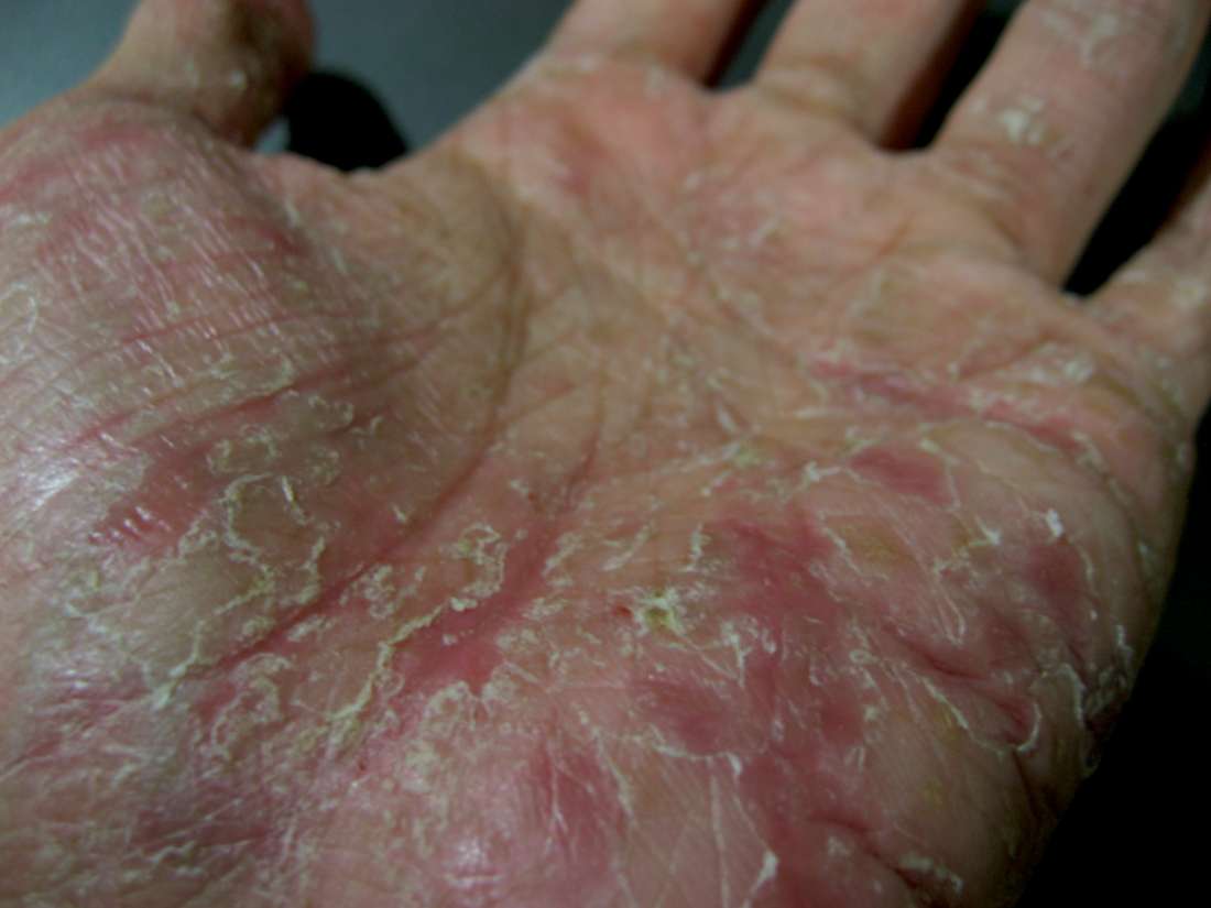 Dyshidrotic Eczema Symptoms Causes And Treatment