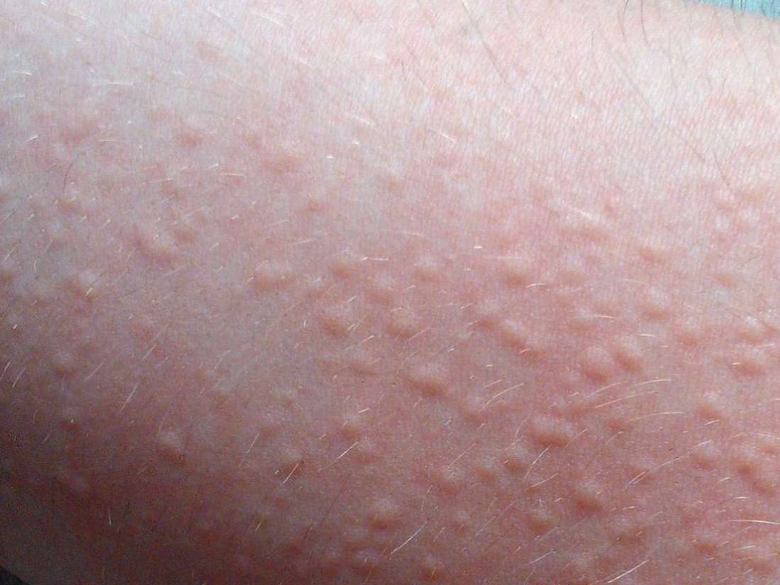 How To Stop A Viral Rash From Itching at Jennifer Grider blog