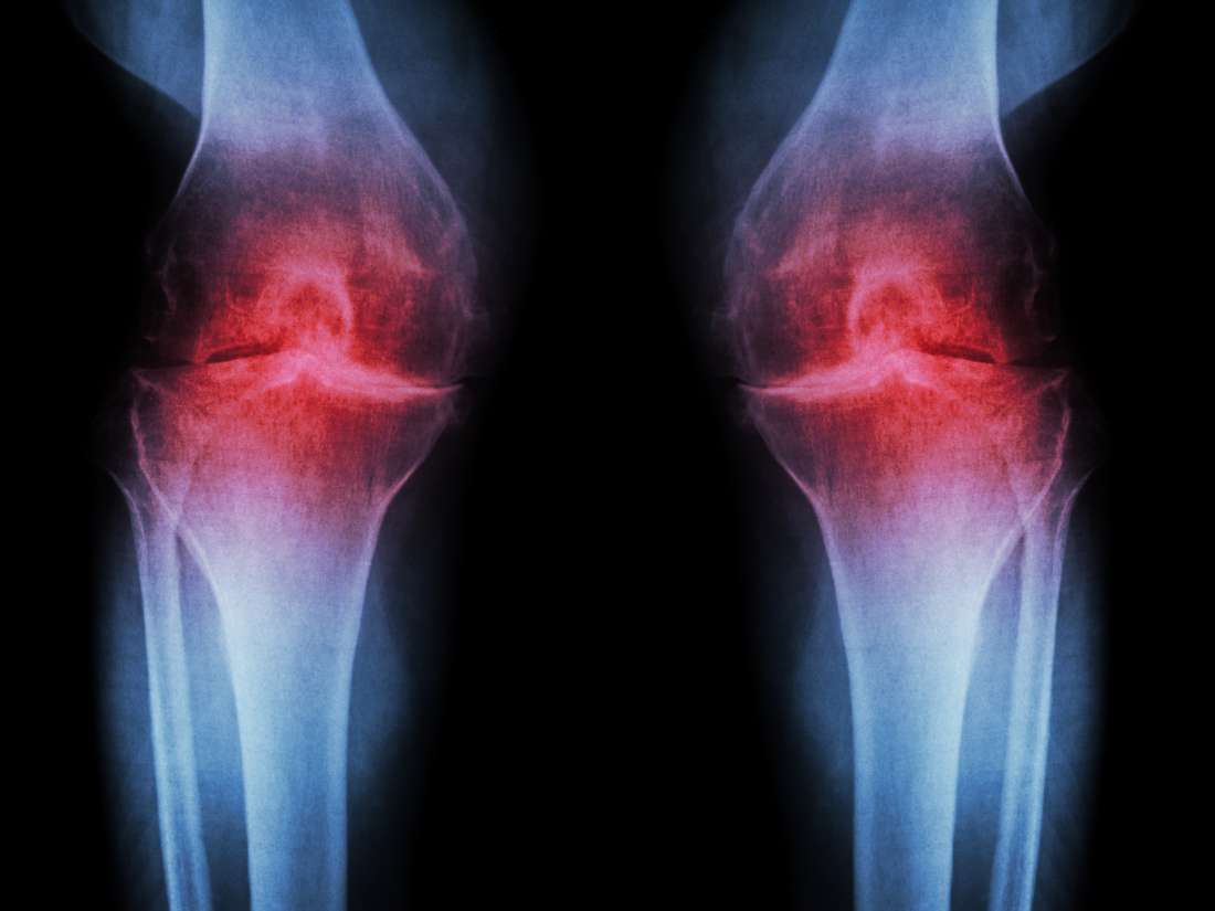 Osteoarthritis: Could researchers have found the key to prevention?