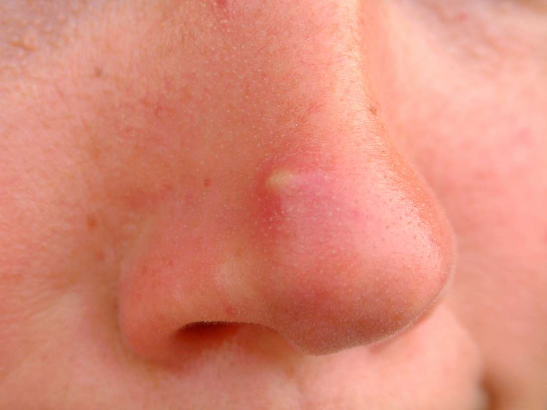 Baby Acne Around Nose And Mouth