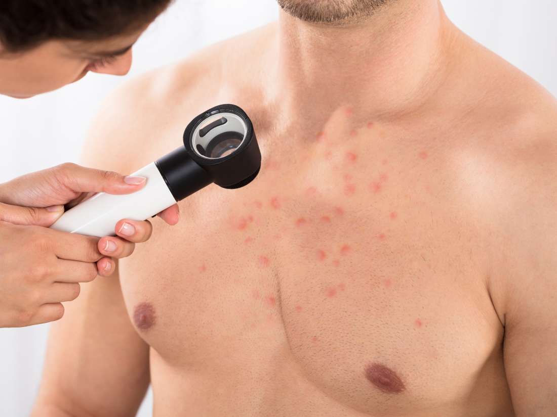 Chest Acne 8 Causes And How To Get Rid Of It