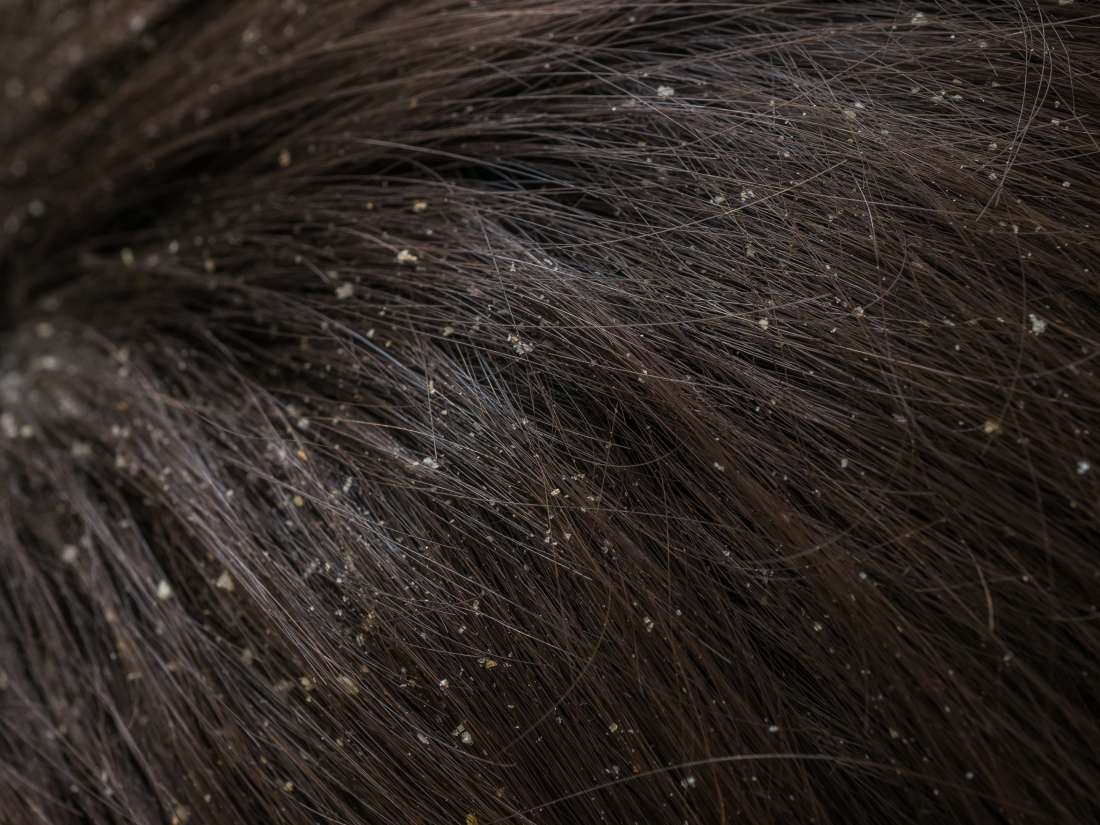 Dandruff: Causes and treatments