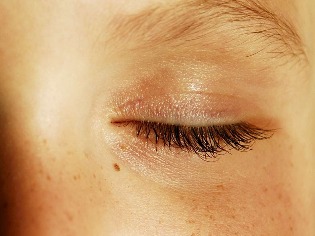 Can You Get Herpes On Your Eyelid At Harvey Berry Blog