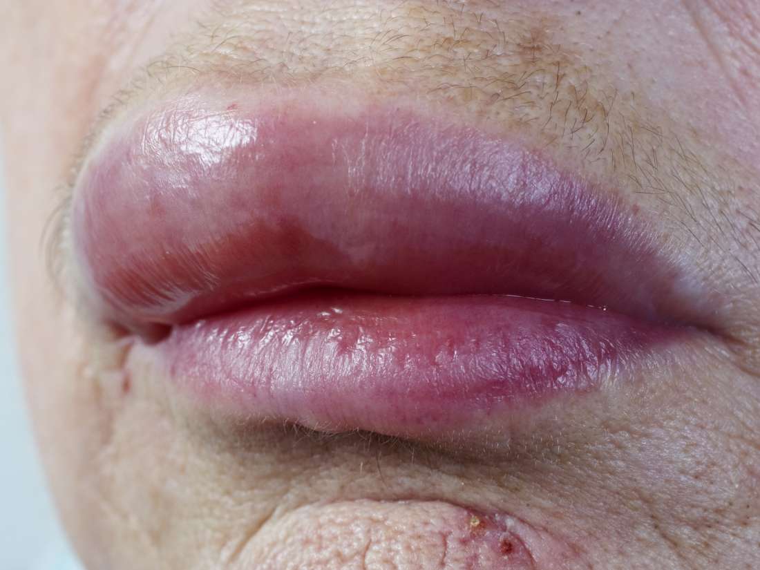 Actinic Cheilitis Causes Treatment And Prevention 