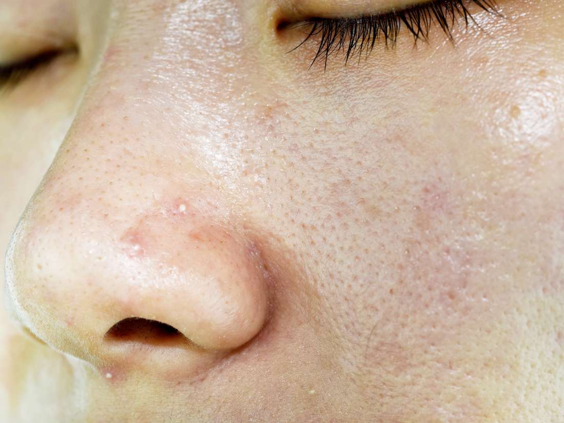 oily-skin-6-treatments-causes-and-prevention