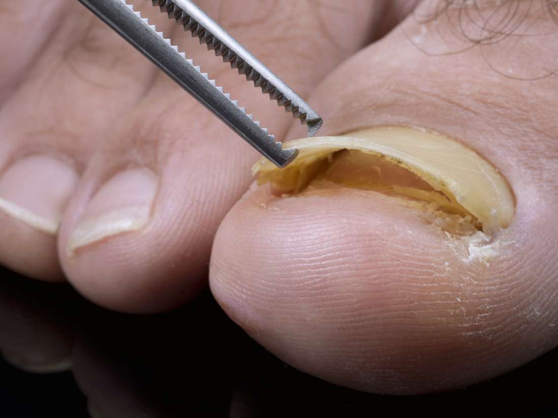 black-toenail-caused-by-diabetes-diabeteswalls