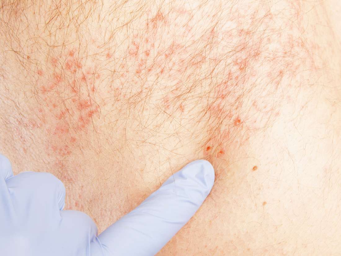 do shingles itch at first