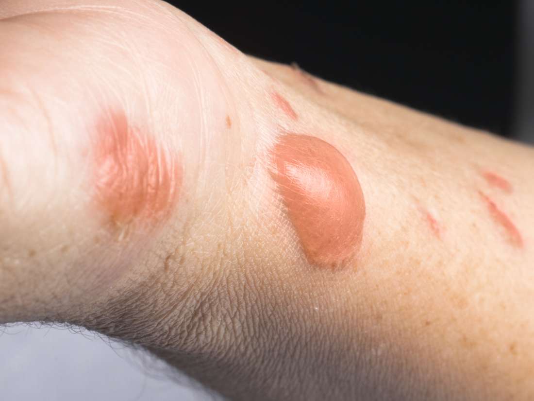 Burn Scars Treatment Removal And Prevention