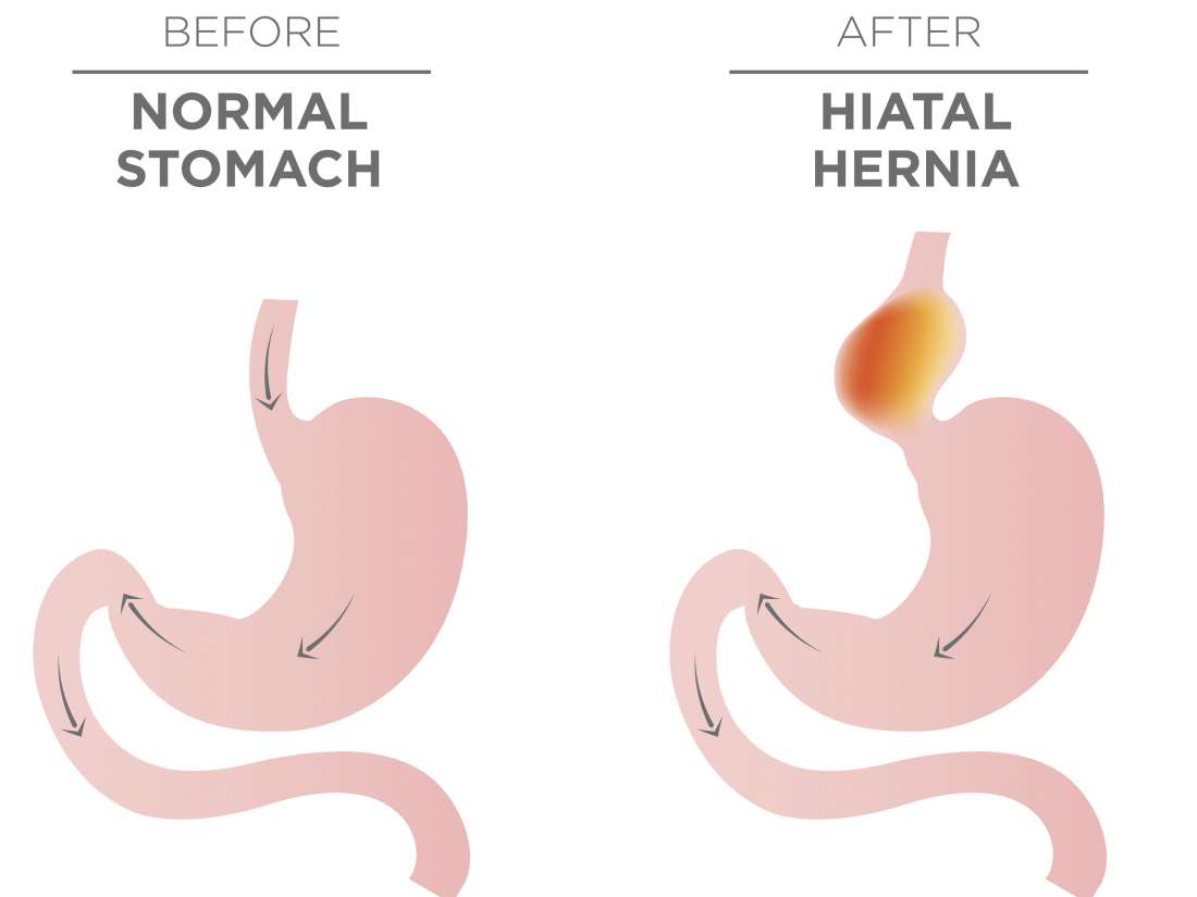 Hiatal hernia surgery: Procedure, recovery, and outlook