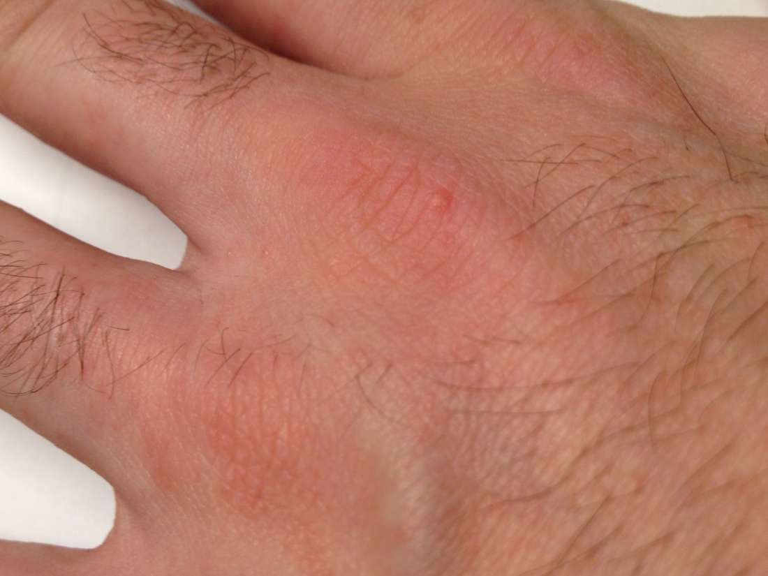 Scabies Rash Between Fingers