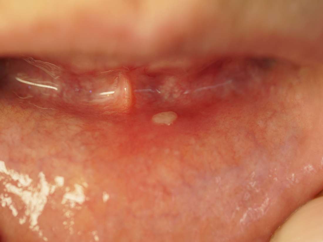 Symptoms, and cancer: Mouth treatment diagnosis,