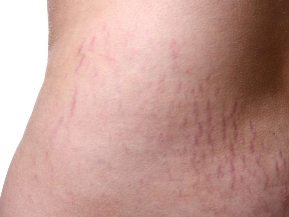 Stretch marks Causes and treatments