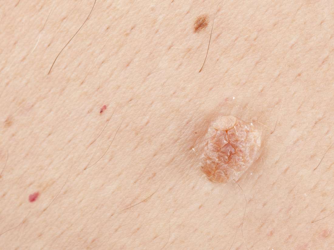 anal skin tag causes