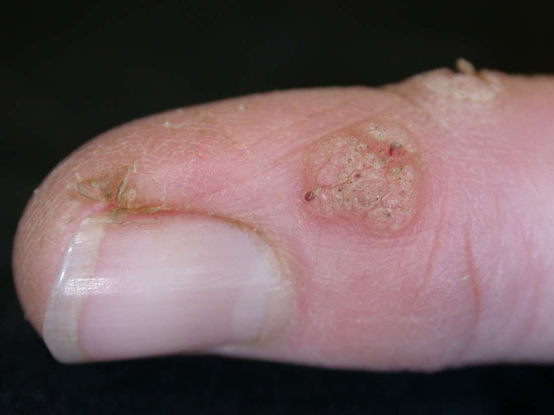 Warts Causes Types And Treatments