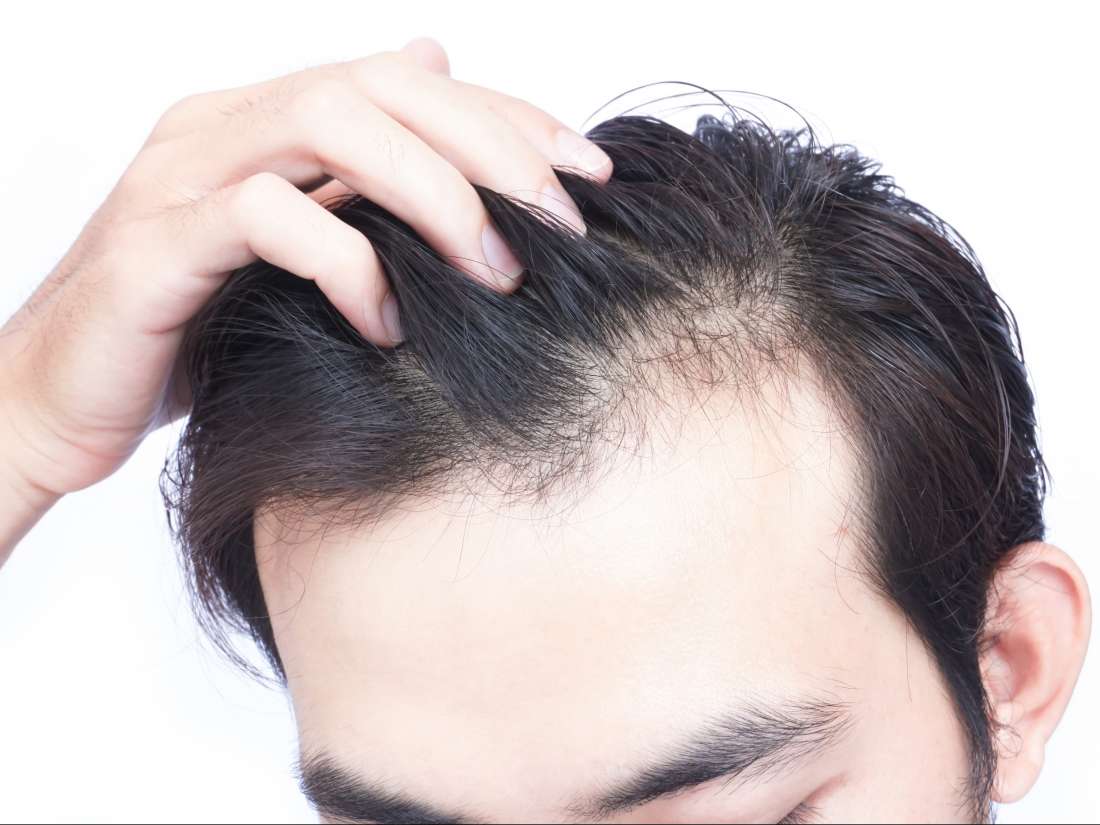 thinning hair: causes, types, treatment, and remedies