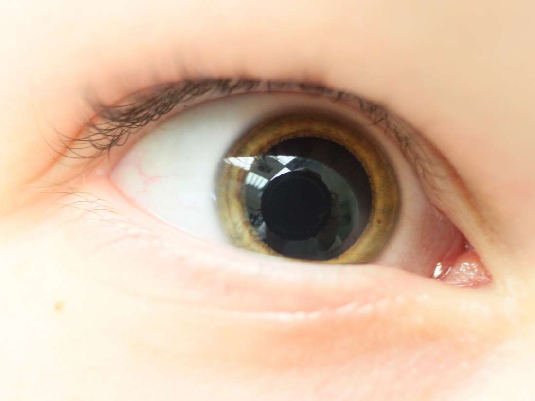 Mydriasis Causes And Treatment For Dilated Pupils