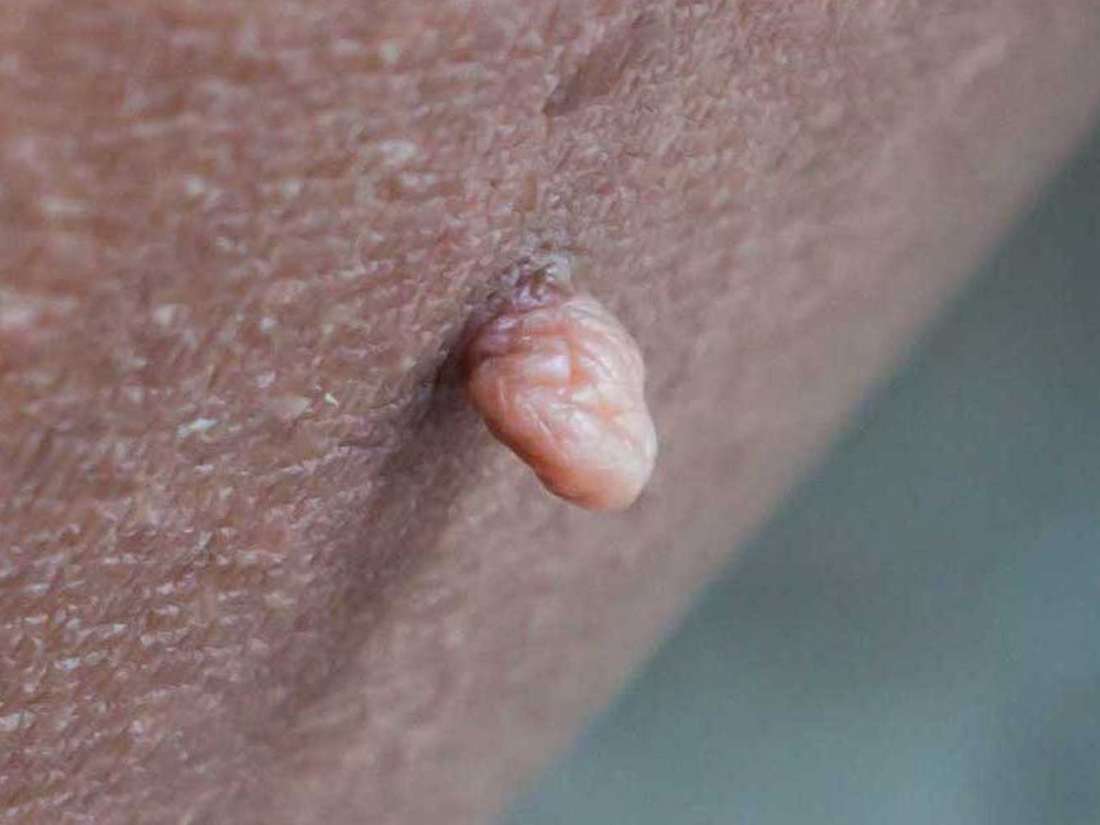 Lump near my vagina