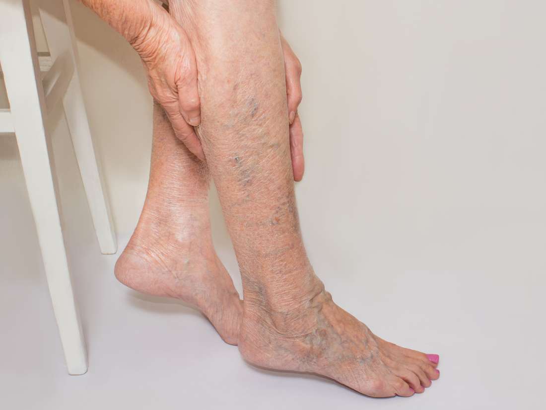 Deep Vein Thrombosis Phentermine