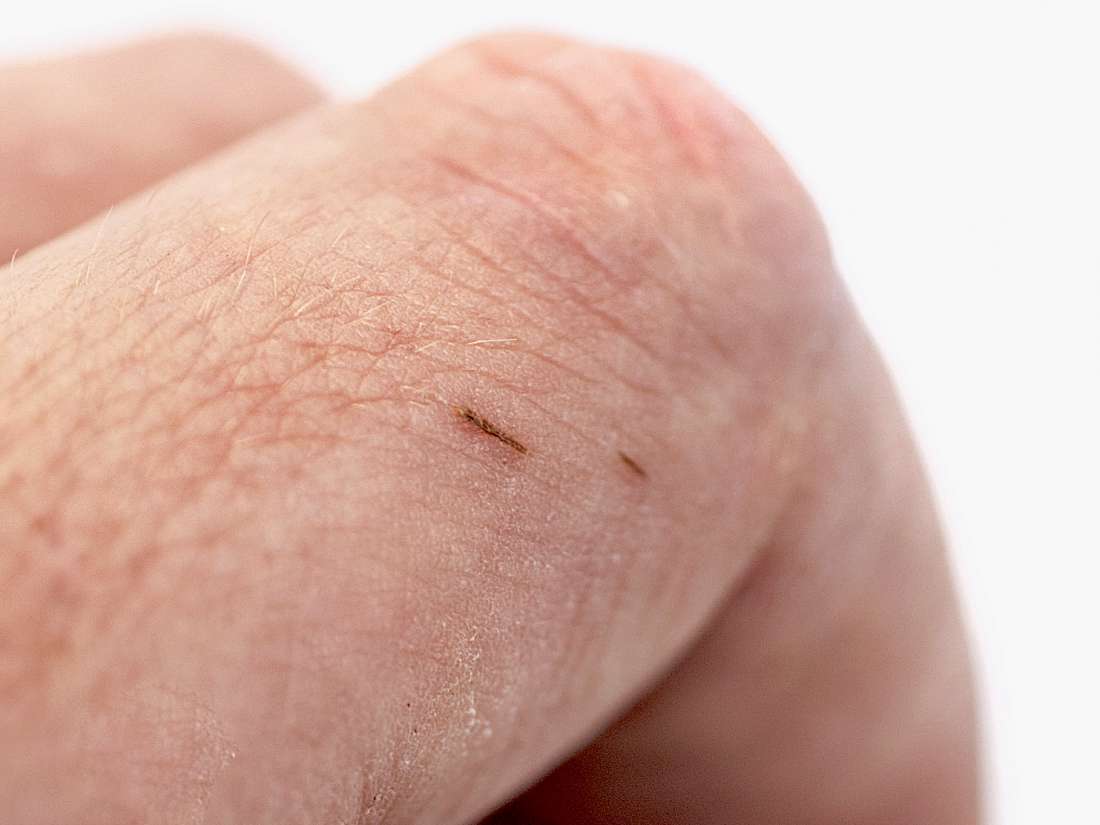 How to remove a splinter Methods and tips