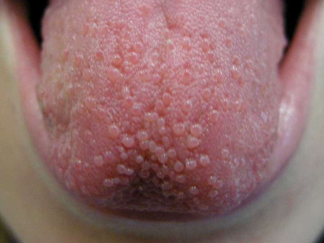 bumps-on-tongue-symptoms-causes-treatment-pictures-diseases-pictures