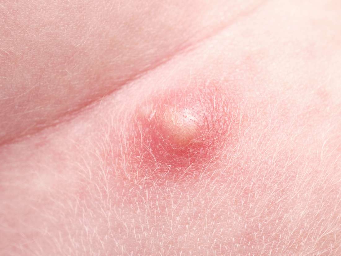 Ingrown Hair Warts On Vag Lips