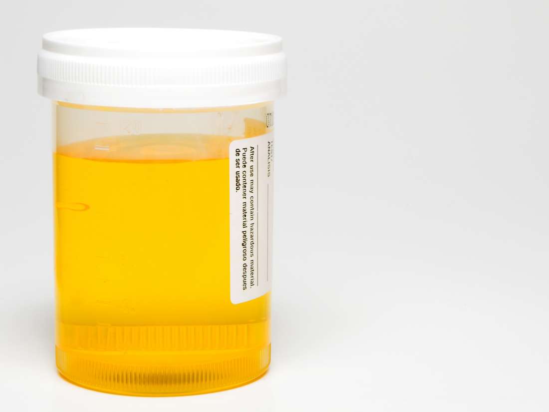 What Causes Your Urine To Turn Yellow at John Hoff blog