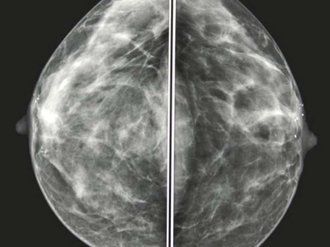 Mammogram images: Normal, abnormal, and breast cancer