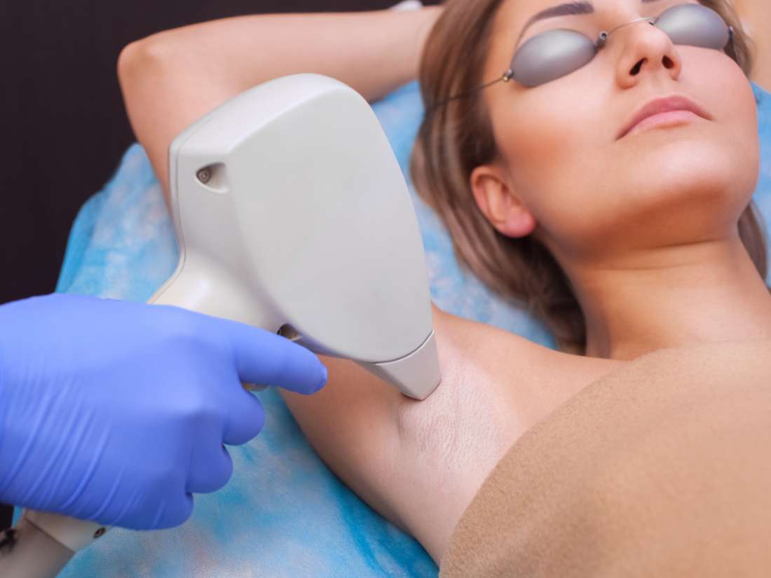 laser treatment for face hair removal