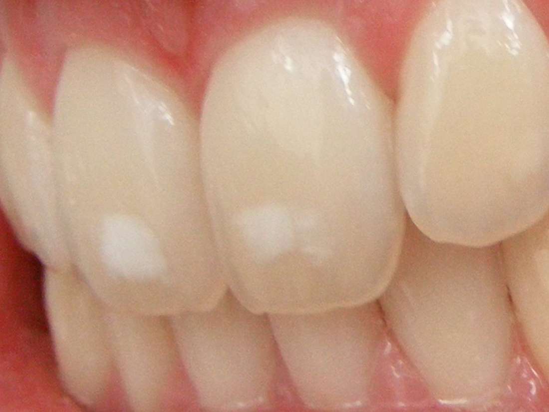 white-spots-on-kids-teeth