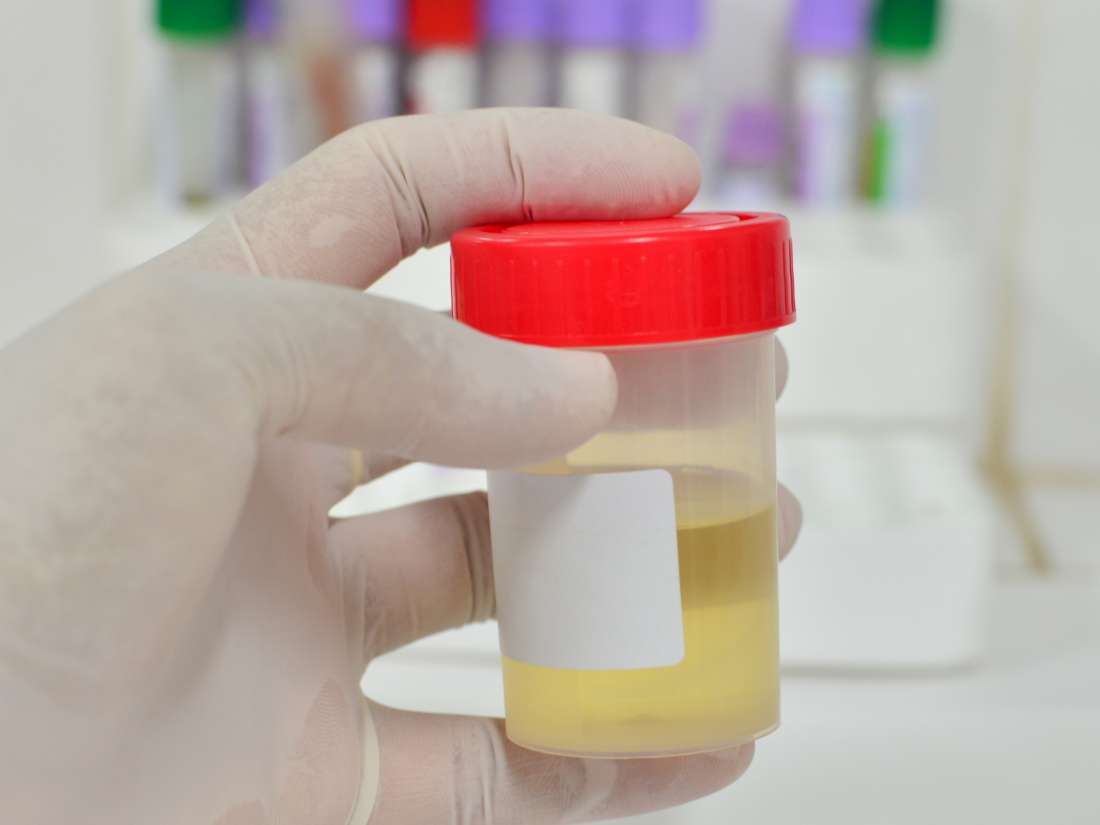 urine-specific-gravity-test-procedure-and-results