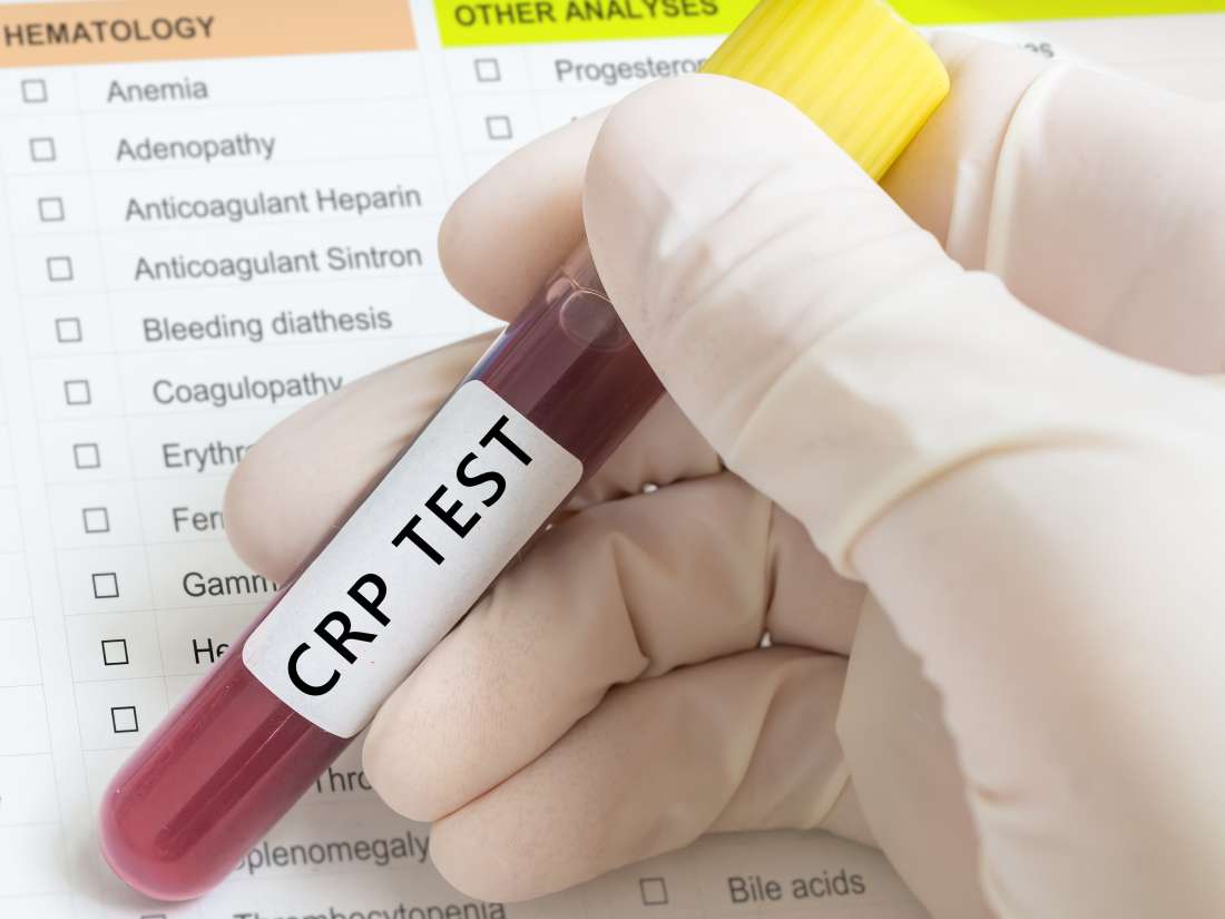 C-reactive protein (CRP) test: High levels, low levels, and normal range