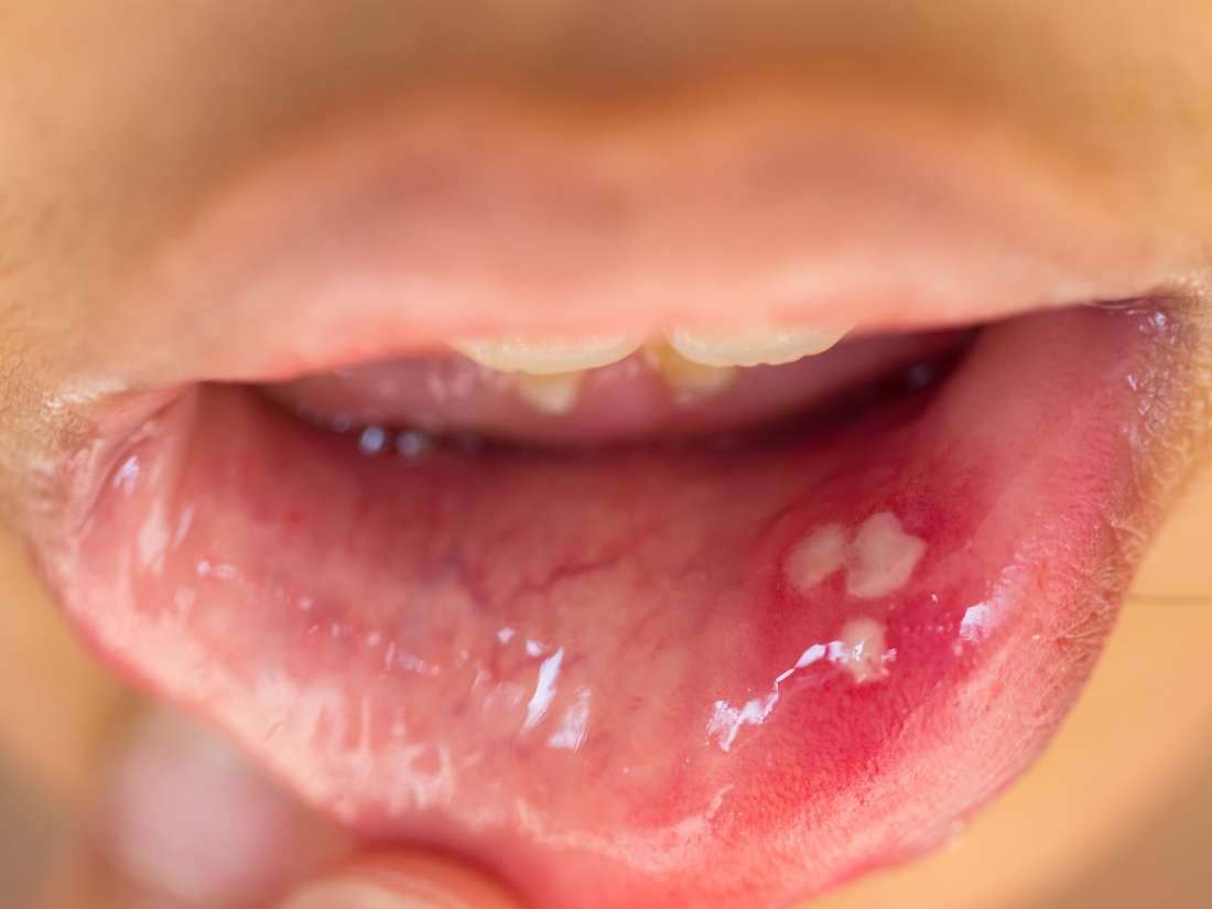 oral for test infection hpv causes, complications, and men: HPV Symptoms, treatment in